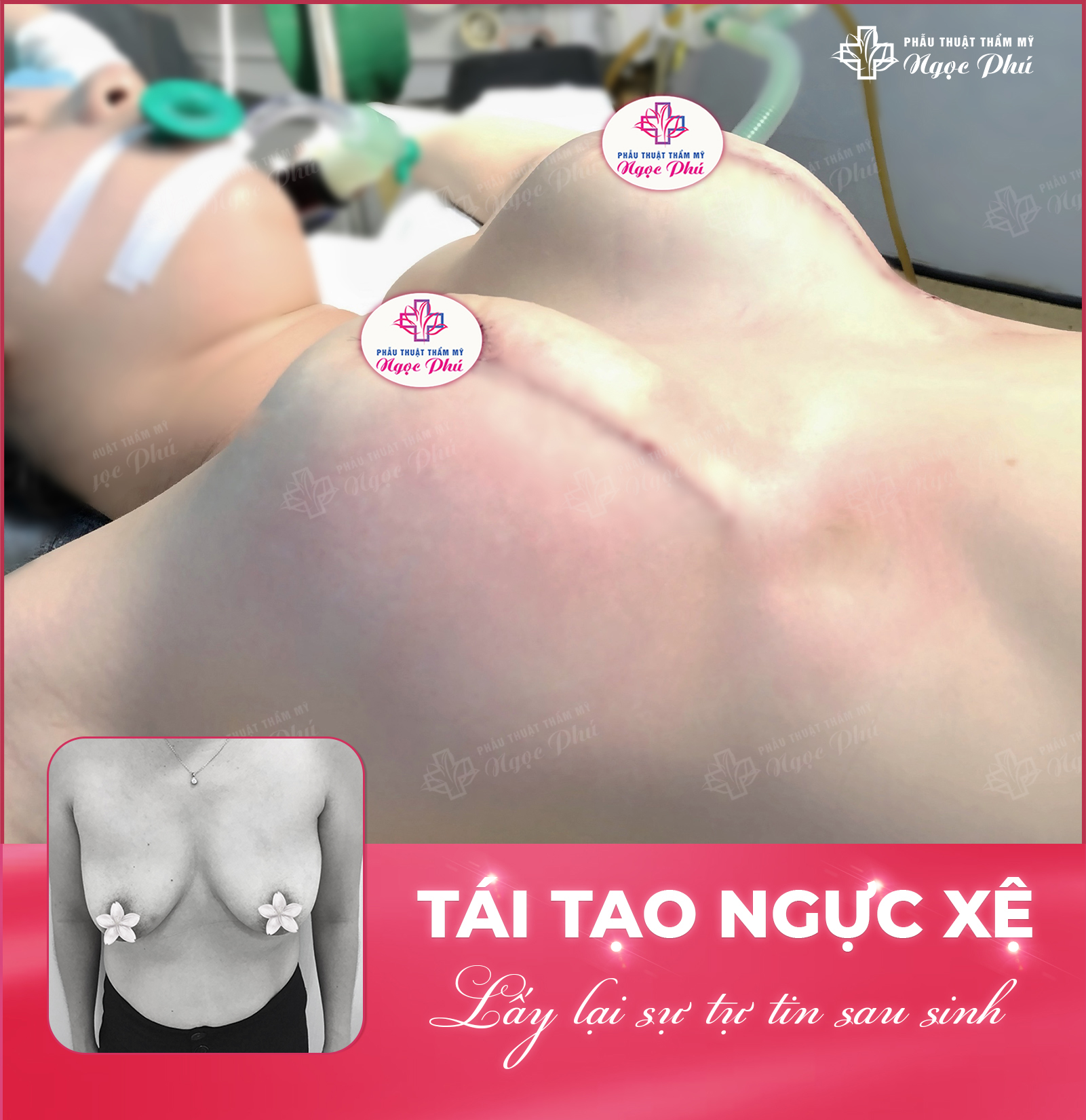 Nâng ngực 6D không chạm tại Thẩm mỹ Ngọc Phú sử dụng túi độn cao cấp, tạo dựng dáng ngực cân đối, hài hòa mà không gây biến chứng về sau.