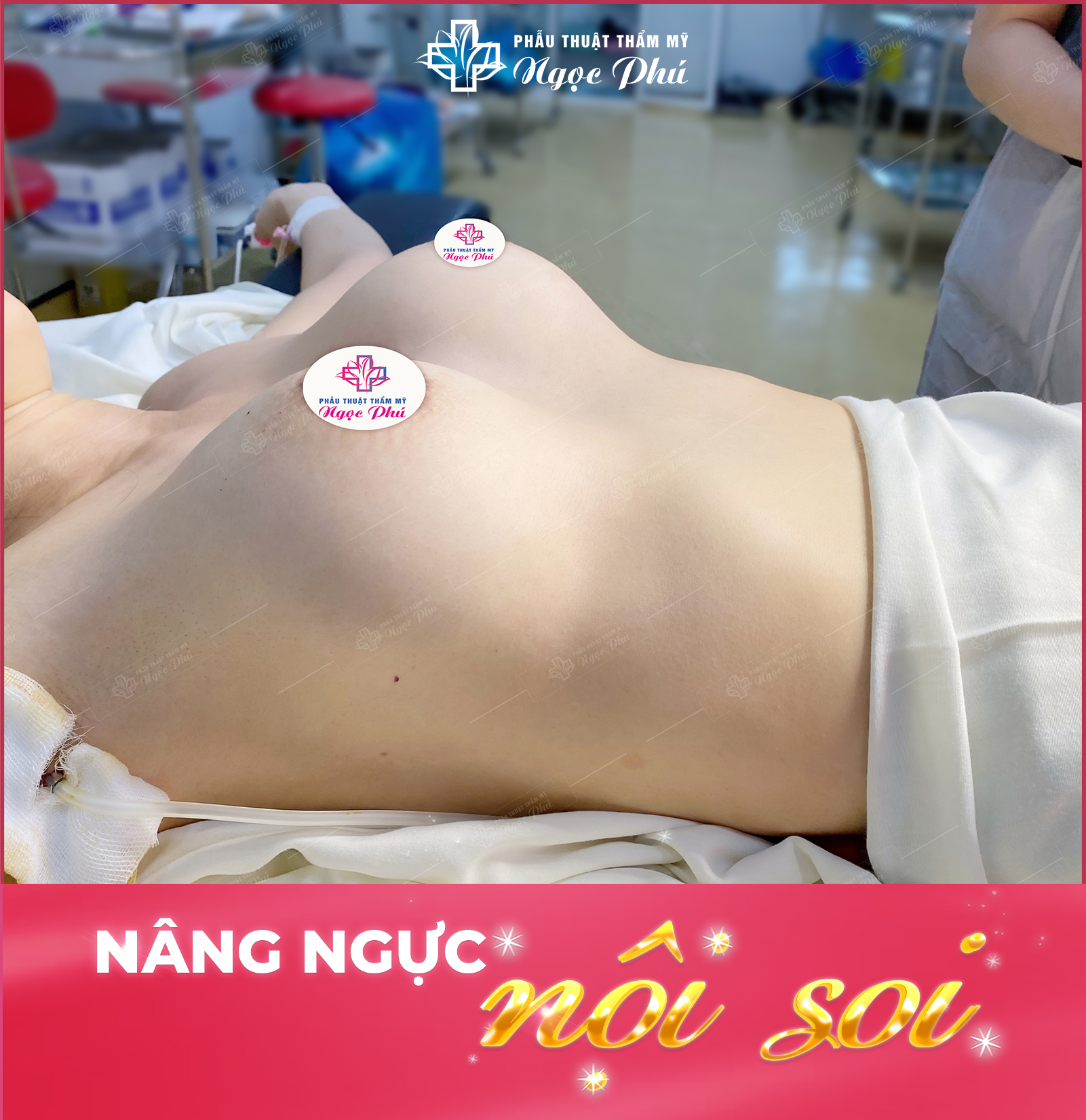 Hình ảnh khách hàng thực tế nâng ngực tại Thẩm mỹ Ngọc Phú