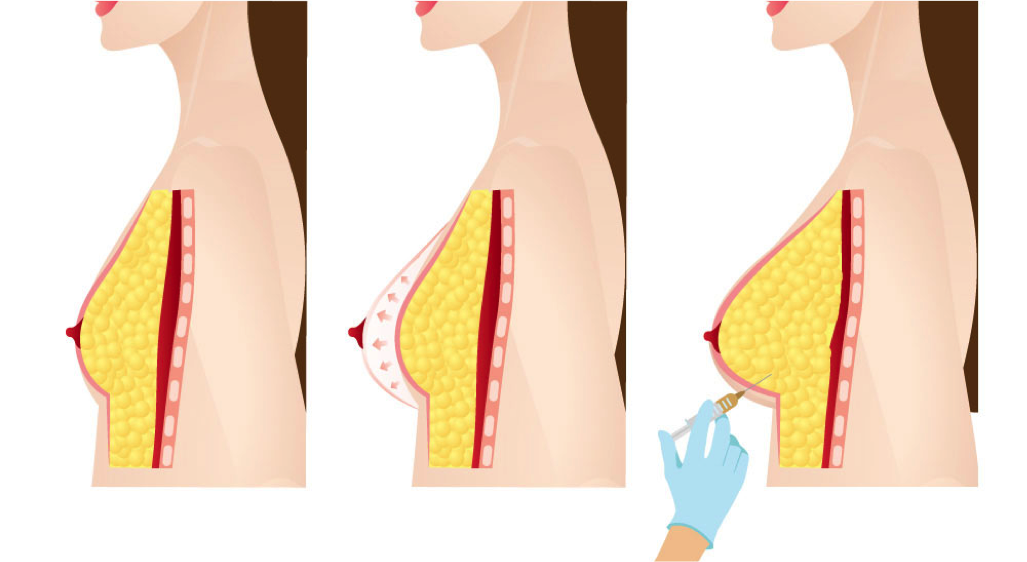 Nâng ngực bằng mỡ tự thân hạn chế quá trình xâm lấn so với nâng ngực phẫu thuật. 