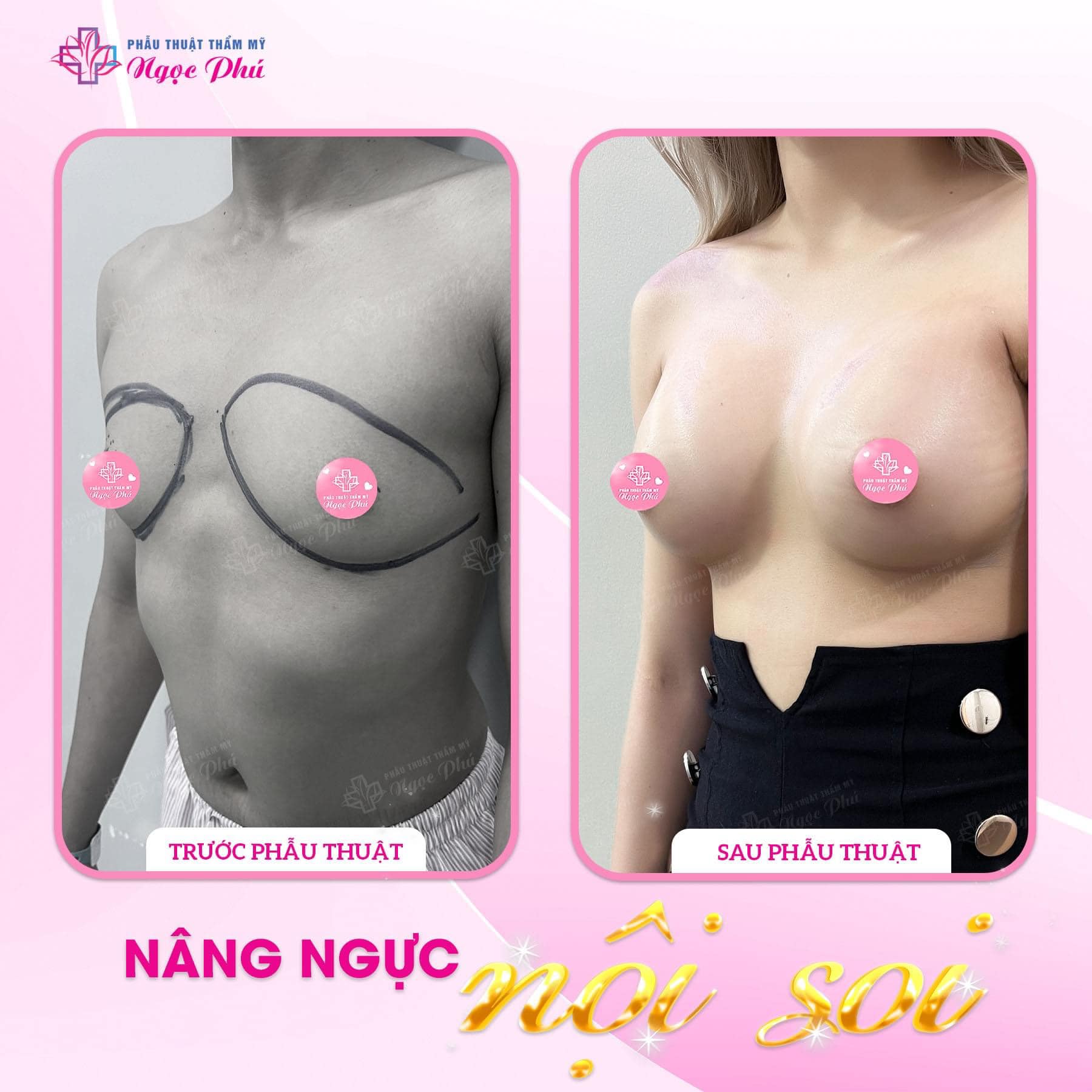 Trong thời gian hồi phục sau phẫu thuật nâng ngực, bạn cần lưu ý theo dõi các dấu hiệu bất thường để kịp thời phát hiện và xử lý các biến chứng
