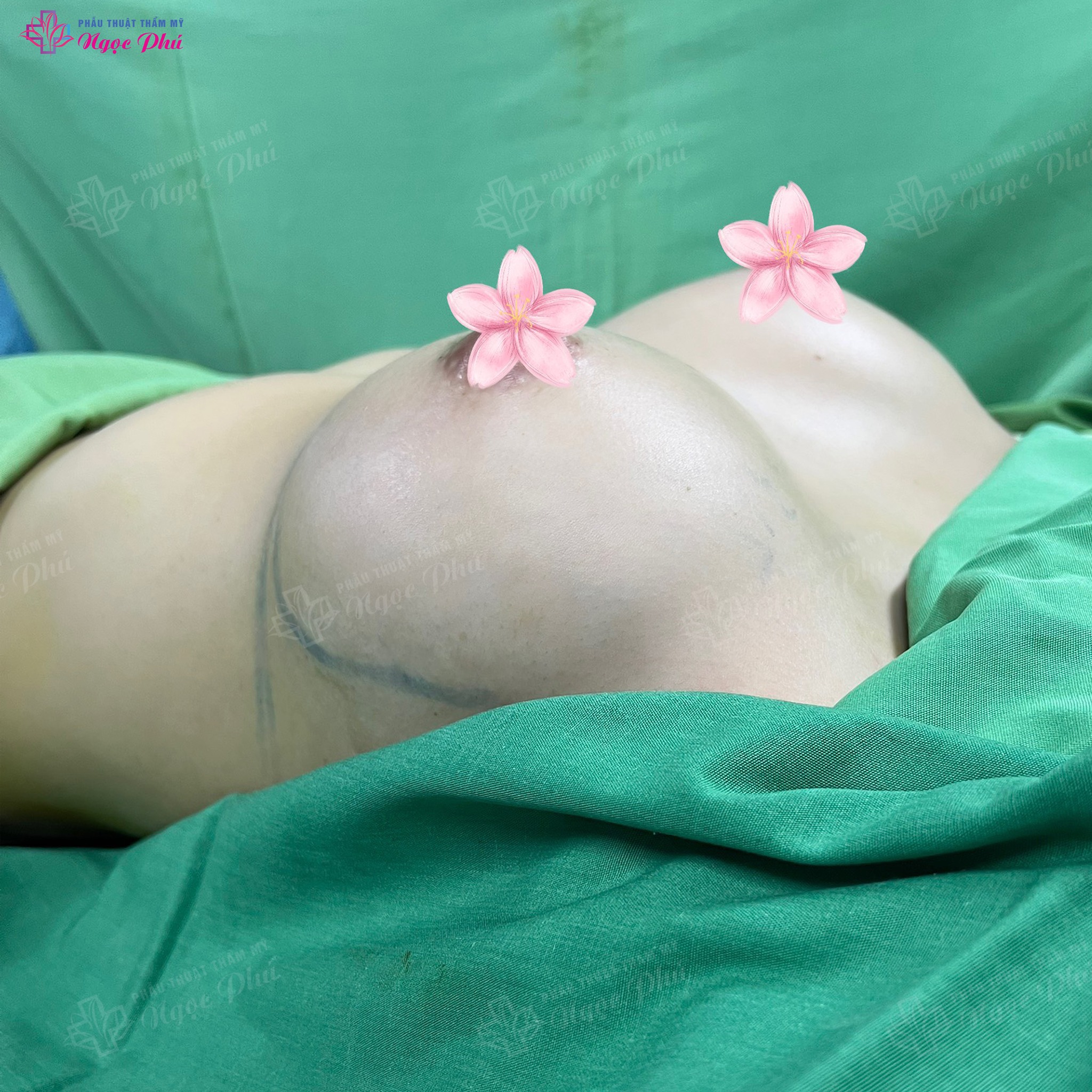 Nâng ngực là một thủ thuật phẫu thuật lớn, do đó sẽ gây đau đớn cho người bệnh.