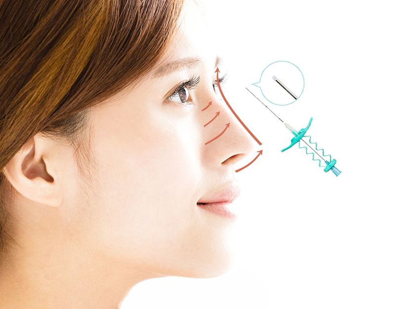 Theo các bác sĩ nói riêng và các chuyên gia thẩm mỹ nói chung, nâng mũi bằng chỉ collagen có thể mang lại kết quả tương đối nếu nơi thực hiện, thực hiện đúng quy trình khử khuẩn và sử dụng chỉ collagen chất lượng có xuất xứ rõ ràng.
