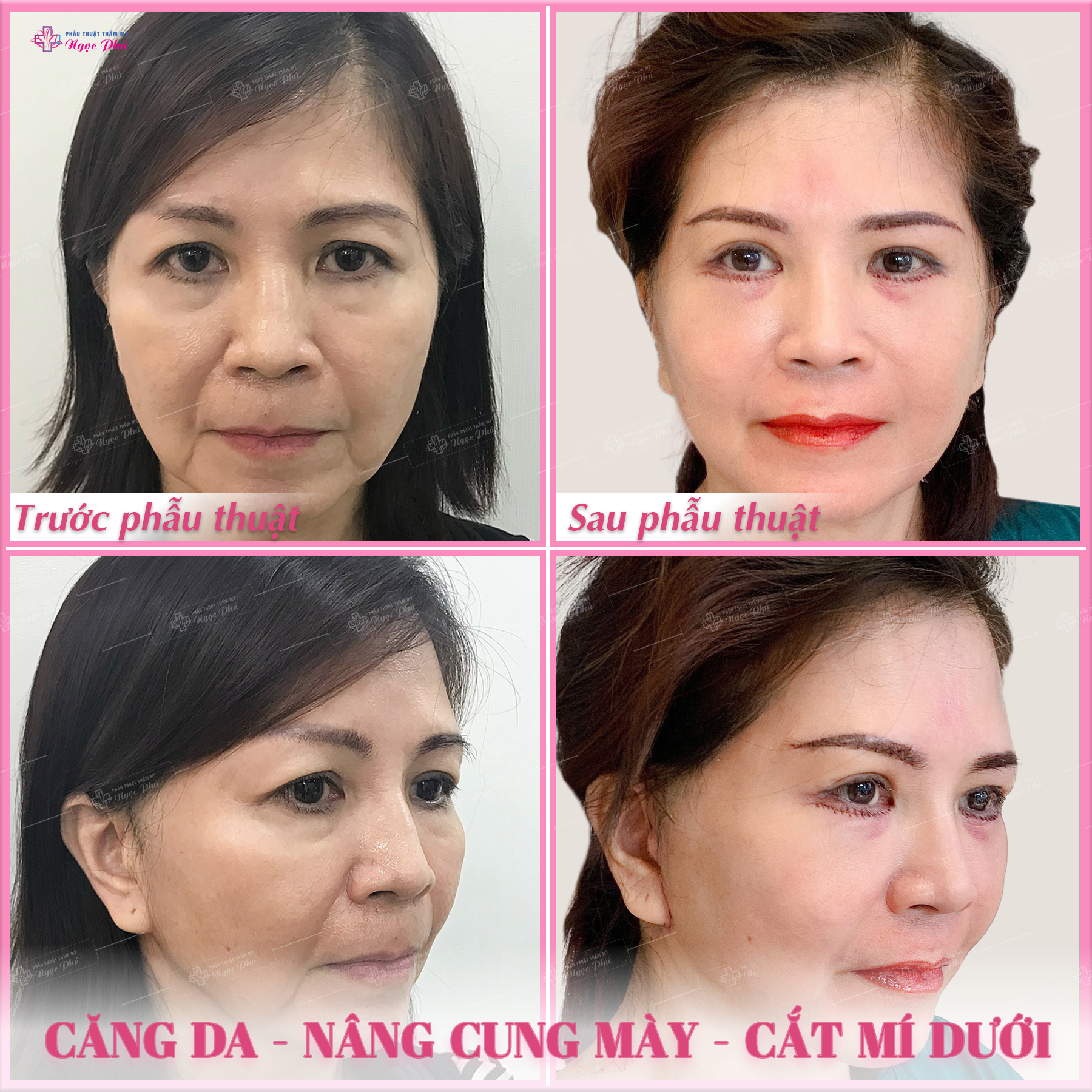 Hình ảnh khách hàng căng da mặt tại Thẩm mỹ Ngọc Phú