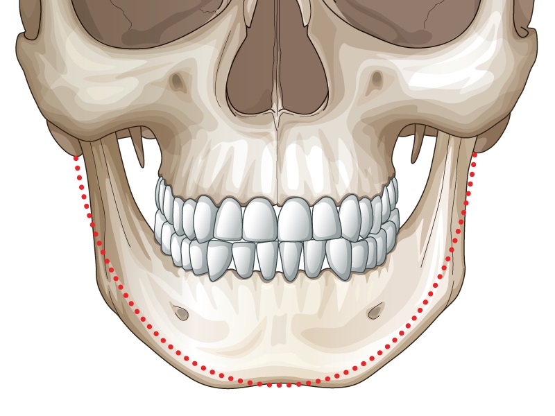 Phẫu thuật gọt hàm là một thủ thuật có thể mang lại hiệu quả cao, giúp khuôn mặt trở nên thon gọn và cân đối hơn.