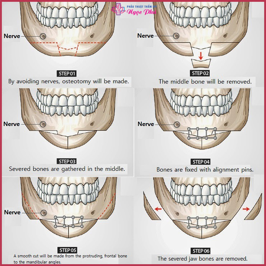 Phẫu thuật gọt hàm còn có thể chỉ định với những khách hàng bị hàm hô, móm. Kết hợp song song với cắt hàm.