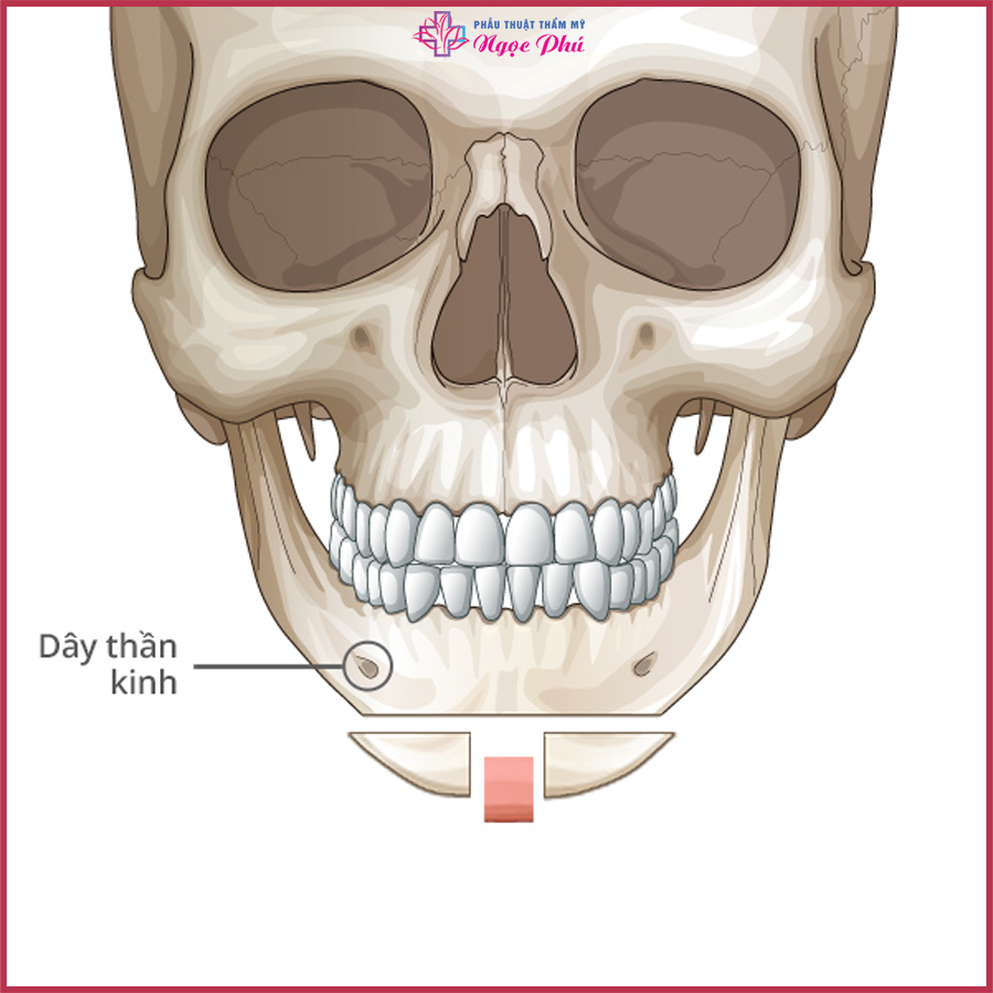 Phẫu thuật gọt hàm là ca đại phẫu xâm lấn phần xương hàm.