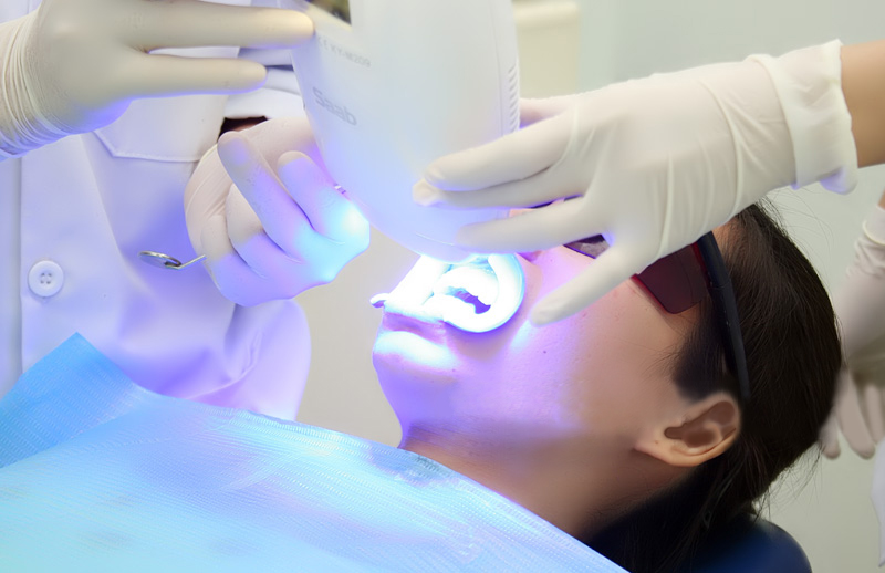 Tẩy trắng răng công nghệ plasma-4